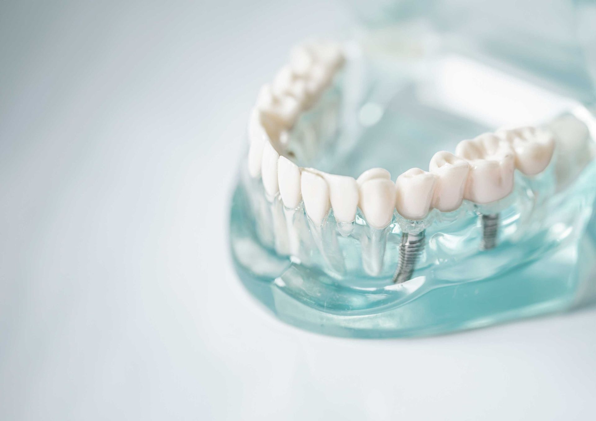 Aditamentos Protesicos